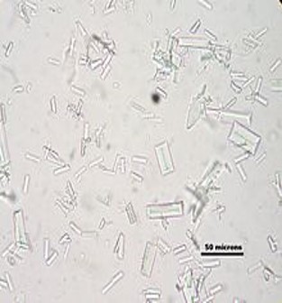 uric acid crystals